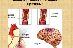 Причины острого инфаркта миокарда