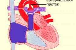 Отсутствие зарастания артериального протока у грудничка - женский тип патологий врожденного порока