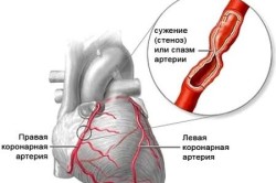 Боли в грудине как симптом стенокардии