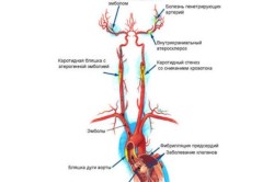 Причины ишемического инсульта 