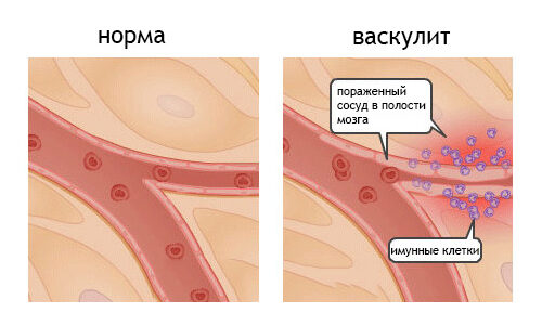 Симптоматика геморрагического васкулита: лечение и диагностика
