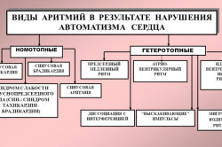 Виды аритмий в результате нарушения автоматизма сердца