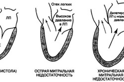 Виды митральной недостаточности