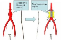 Схема протезирования аневризмы брюшной аорты