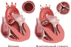 Схема стеноза аортального клапана