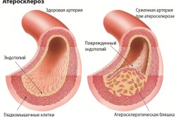 Схема атеросклероза