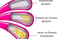 Схема церебрального атеросклероза сосудов головного мозга