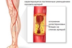 Атеросклероз - отложение бляшек холестерина на стенках сосудов