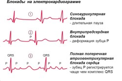 Степени блокады сердца на экг