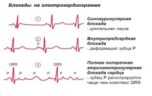 Чем опасна для здоровья блокада сердца?