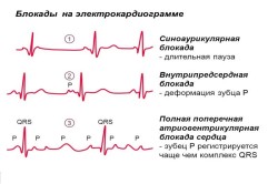 Блокады на ЭКГ