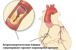 Ишемической болезнь сердца