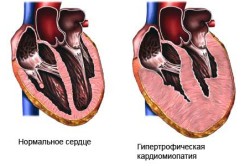 Схема кардиомиопатии