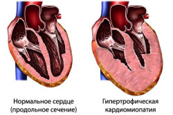 Схема гипертрофической кардиомиопатии