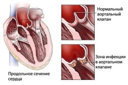 Схема ревматизма сердца