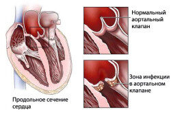Профилактика эндокардита симптомы и лечение