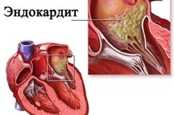 Эндокардит при гипертрофической кардиомиопатии