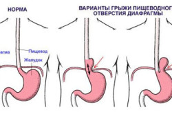 Защемление желудка при грыже диафрагмы