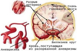 Схема геморрагического инсульта