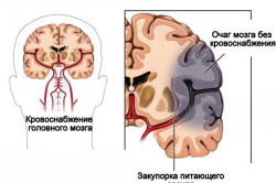 Механизм развития ишемического инсульта 
