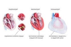 Заболевания сердца как причина боли в грудине