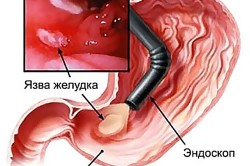 Болевой синдром в грудине при язве желудка