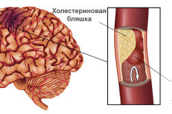 Симптомы и лечение транзиторной ишемической атаки