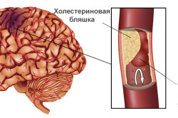 Транзиторная ишемическая атака - переходящее нарушение кровообращения мозга