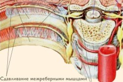 Герпетическая невралгия - причина колющей боли в сердце