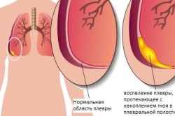 Плеврит
