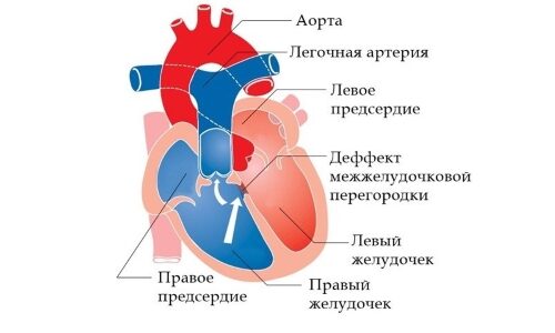 Шумы в сердце у ребенка: симптомы и причины возникновения