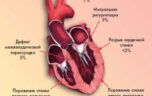 Если случился кардиогенный шок — неотложная помощь (алгоритм) следующие