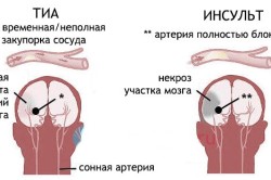Транзиторная ишемическая атака и инсульт