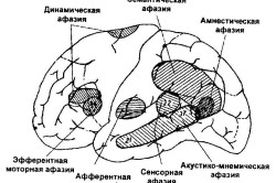 Виды афазий в зависимости от локализации поражения больших полушарий