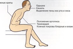Симптомы ортопноэ