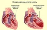 Какие бывают симптомы сердечной недостаточности у женщин?